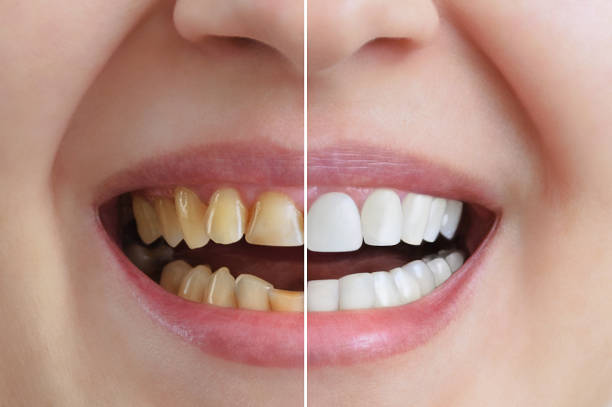 Cosmetic Dentist in Wakad - Wonder Glow and Smile Clinic